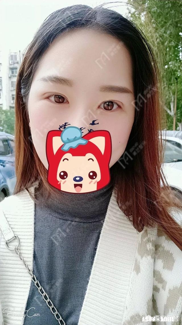 双眼皮割多宽最好看有什么好建议