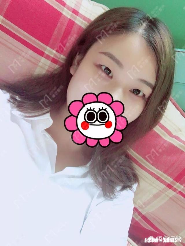 双眼皮割多宽最好看有什么好建议