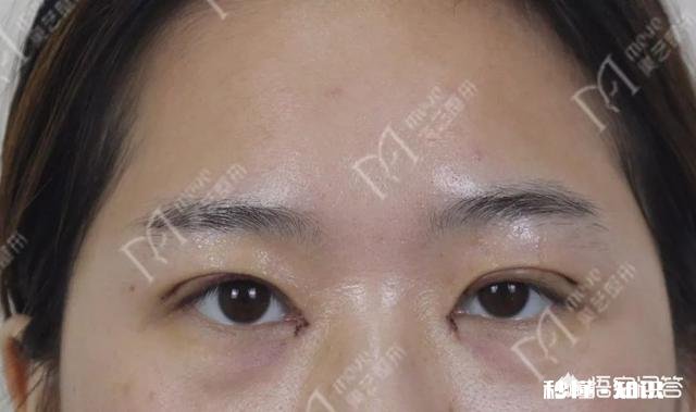 双眼皮割多宽最好看有什么好建议