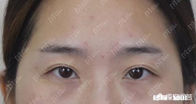 双眼皮割多宽最好看有什么好建议