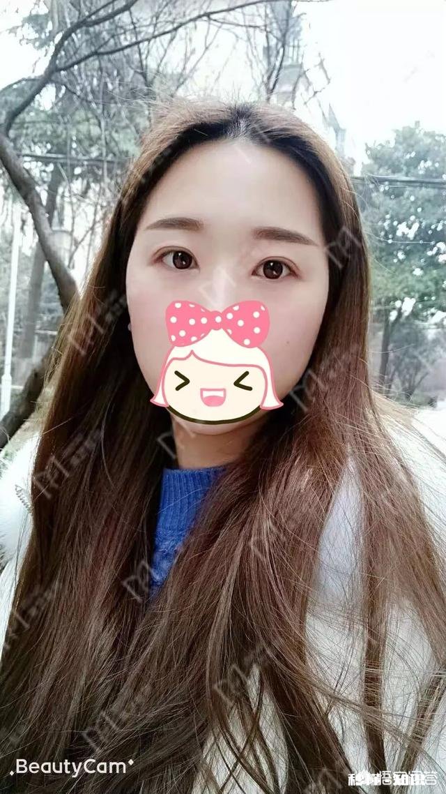 双眼皮割多宽最好看有什么好建议