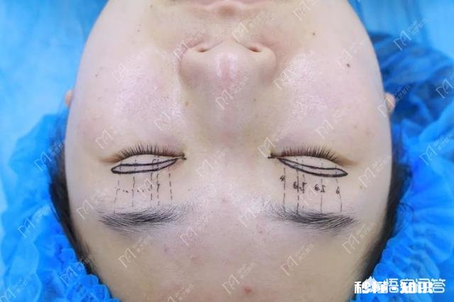 双眼皮割多宽最好看有什么好建议