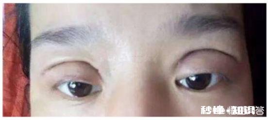 双眼皮割多宽最好看有什么好建议