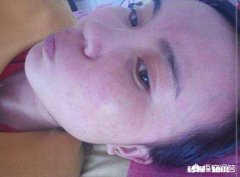 脸上有痘印，敏感肌肤，适合用什么护肤品