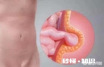 一岁两个月男宝，右侧腹股沟斜疝、左侧鞘膜积液，是否要手术