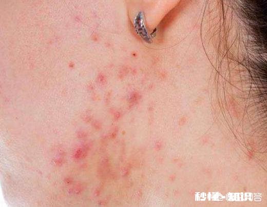 皮肤的好坏，跟螨虫有关系吗