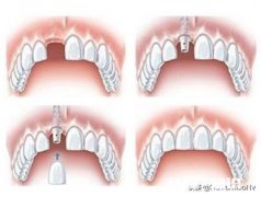 为什么牙医都说种植牙好