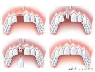 为什么牙医都说种植牙好