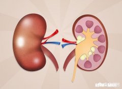 尿结石会对肾造成损伤吗