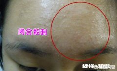 “闭口粉刺”是由于什么习惯造成的能祛除吗