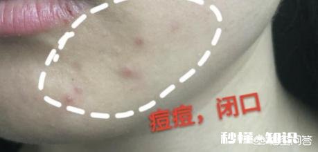 “闭口粉刺”是由于什么习惯造成的能祛除吗
