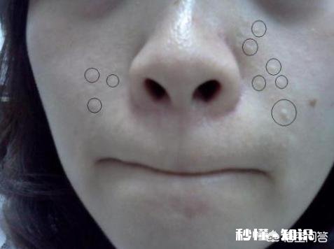 “闭口粉刺”是由于什么习惯造成的能祛除吗