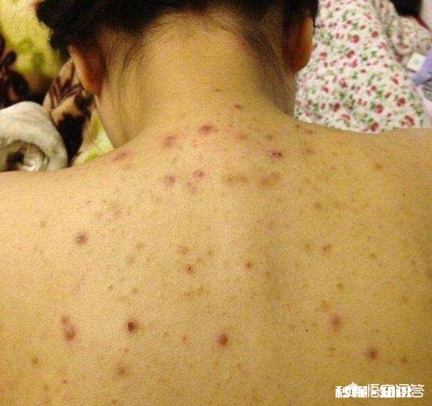 后背有螨虫时,一般会有哪几个特征有螨虫就该全部除掉吗