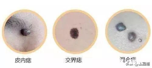 身体痣越来越多，都是小点痣，什么原因