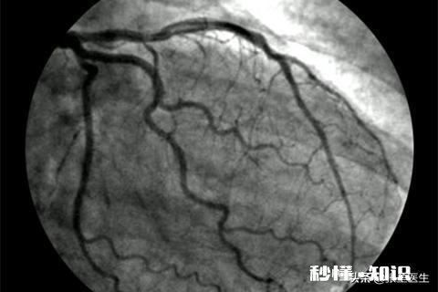 心脏不好，应该在饮食注意什么哪些运动对可以锻炼心脏