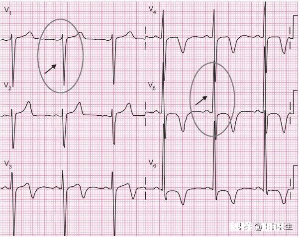 心脏不好，应该在饮食注意什么哪些运动对可以锻炼心脏