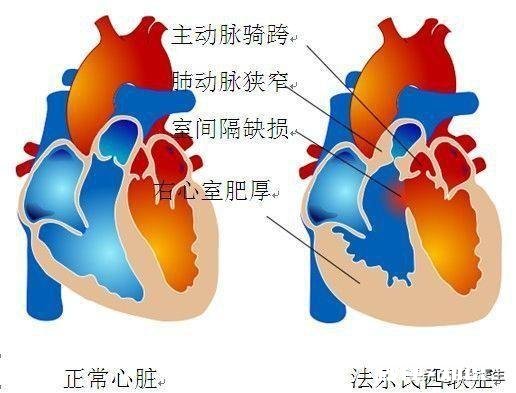 心脏不好，应该在饮食注意什么哪些运动对可以锻炼心脏