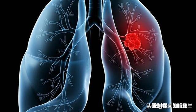 早期肺癌，除了手术外还可以怎么治疗
