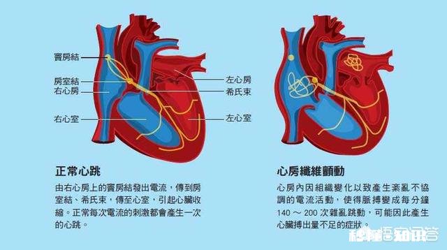 房颤患者怎样才能有效预防脑卒中