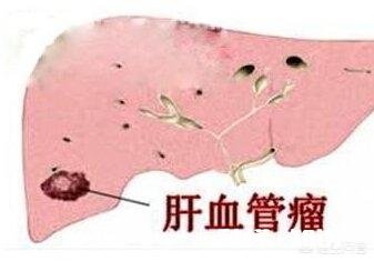 报告下面提示写:肝脏右叶均质性高回声灶，血管瘤与其他鉴别。医生说没事，真没事吗