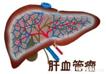 报告下面提示写:肝脏右叶均质性高回声灶，血管瘤与其他鉴别。医生说没事，真没事吗