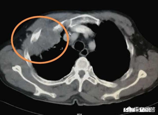 多数人患上癌症后，为何有人几个月就离世有人却非常长寿