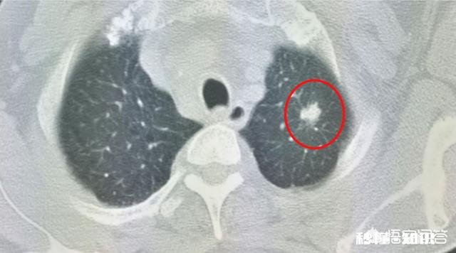 多数人患上癌症后，为何有人几个月就离世有人却非常长寿