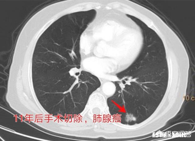 多数人患上癌症后，为何有人几个月就离世有人却非常长寿