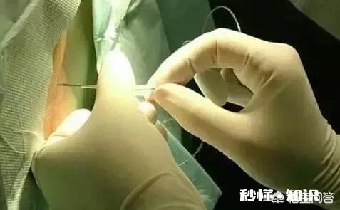 打完无痛分娩脊柱疼，多久能恢复