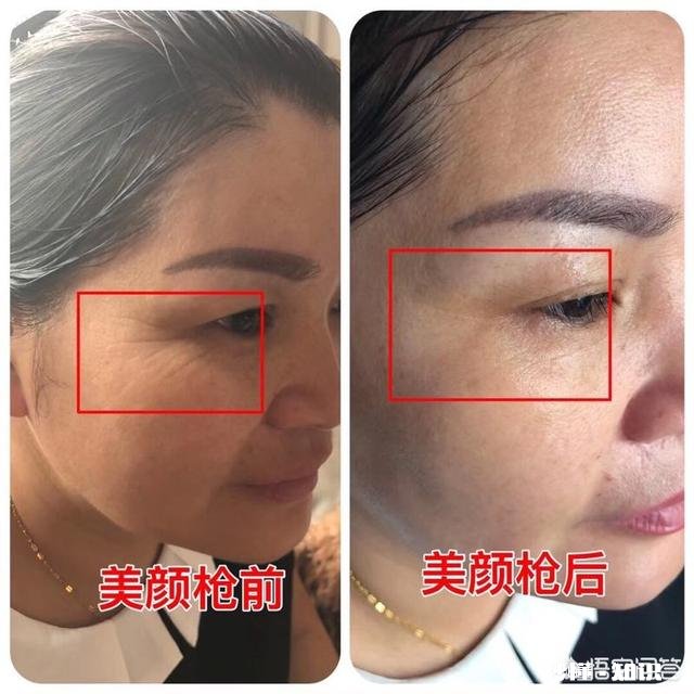 有什么办法可以彻底祛除细纹