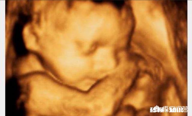 孕期的NT检查跟四维彩超都是必做的检查项目吗