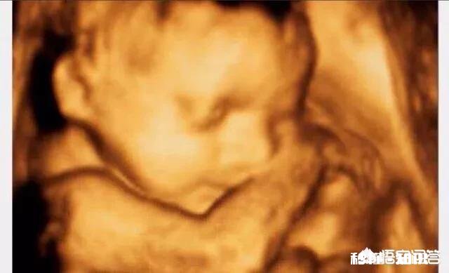 孕期的NT检查跟四维彩超都是必做的检查项目吗