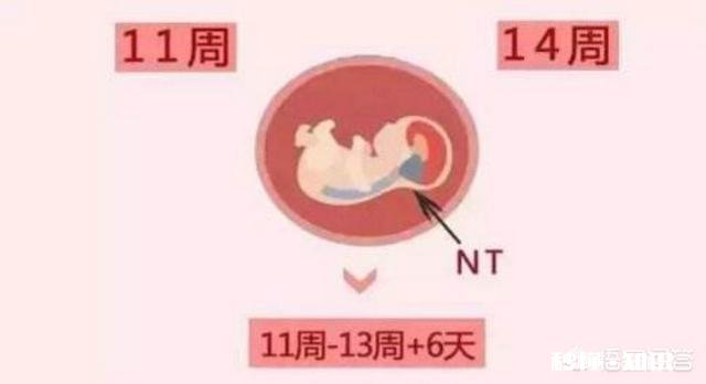 孕期的NT检查跟四维彩超都是必做的检查项目吗