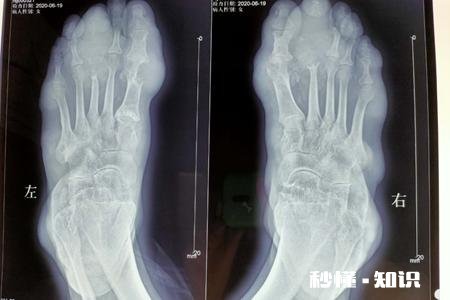 痛风需要做哪几项检查