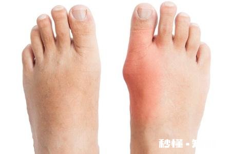 痛风需要做哪几项检查