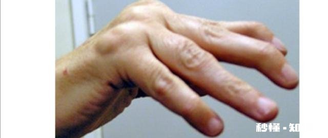 什么是类风湿病