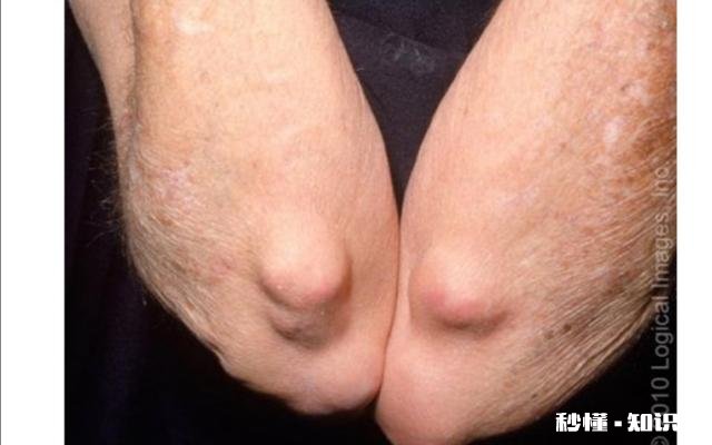 什么是类风湿病