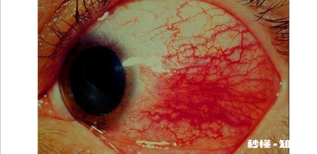 什么是类风湿病