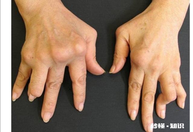 什么是类风湿病