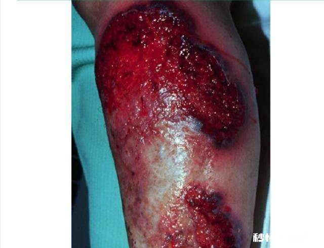 什么是类风湿病