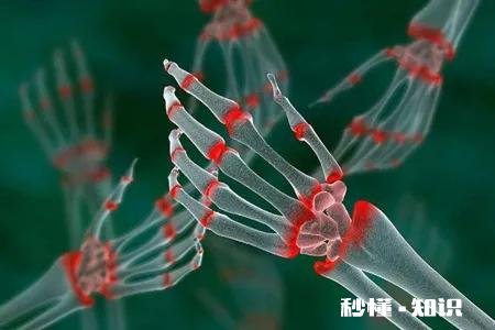 什么是类风湿病