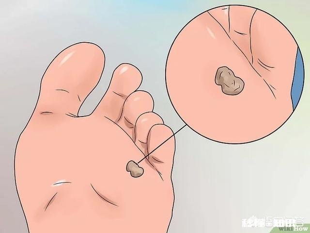 脚下长老茧怎么办