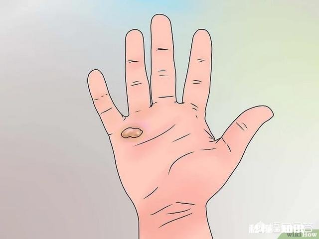 脚下长老茧怎么办