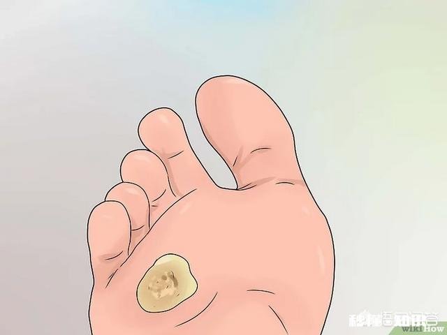 脚下长老茧怎么办