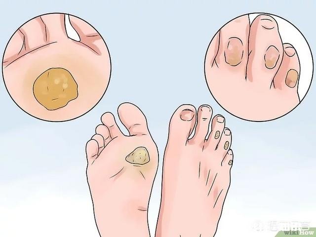 脚下长老茧怎么办