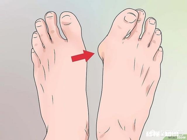 脚下长老茧怎么办