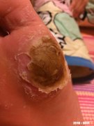 脚下长老茧怎么办