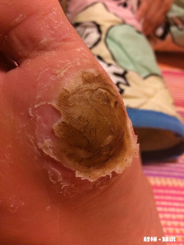 脚下长老茧怎么办