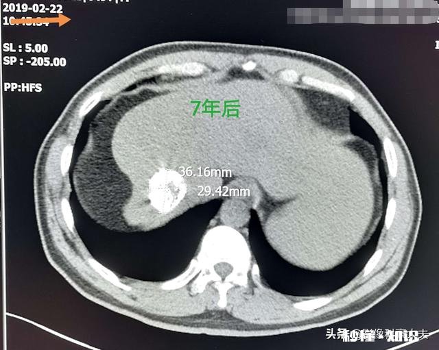 为什么说癌症是慢性病