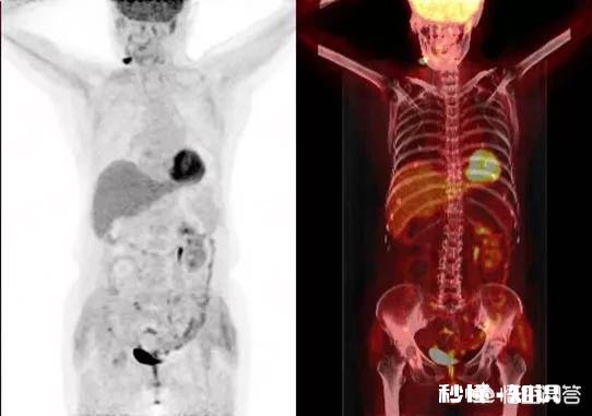 为什么说癌症是慢性病